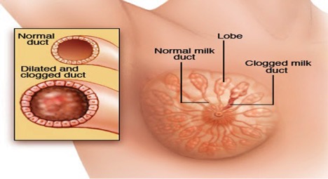 breast